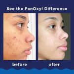 PanOxyl  Acne Foaming Wash Benzoyl Peroxide 10% Maximum Strength 156g