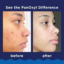 PanOxyl  Acne Foaming Wash Benzoyl Peroxide 10% Maximum Strength 156g