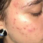 PanOxyl  Acne Foaming Wash Benzoyl Peroxide 10% Maximum Strength 156g