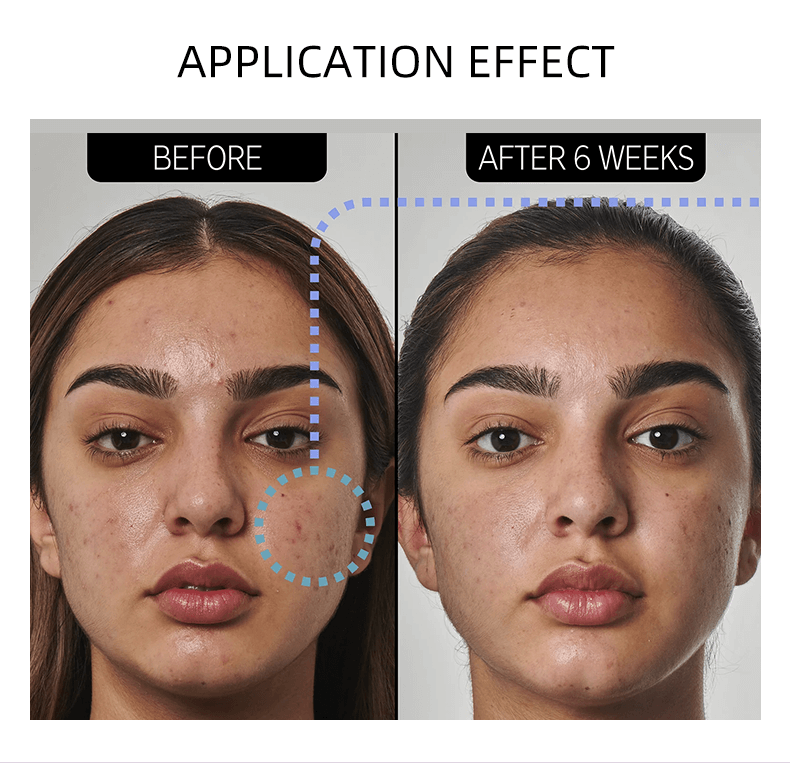 PanOxyl  Acne Foaming Wash Benzoyl Peroxide 10% Maximum Strength 156g