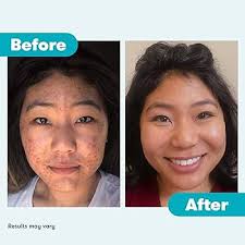 PanOxyl  Acne Foaming Wash Benzoyl Peroxide 10% Maximum Strength 156g