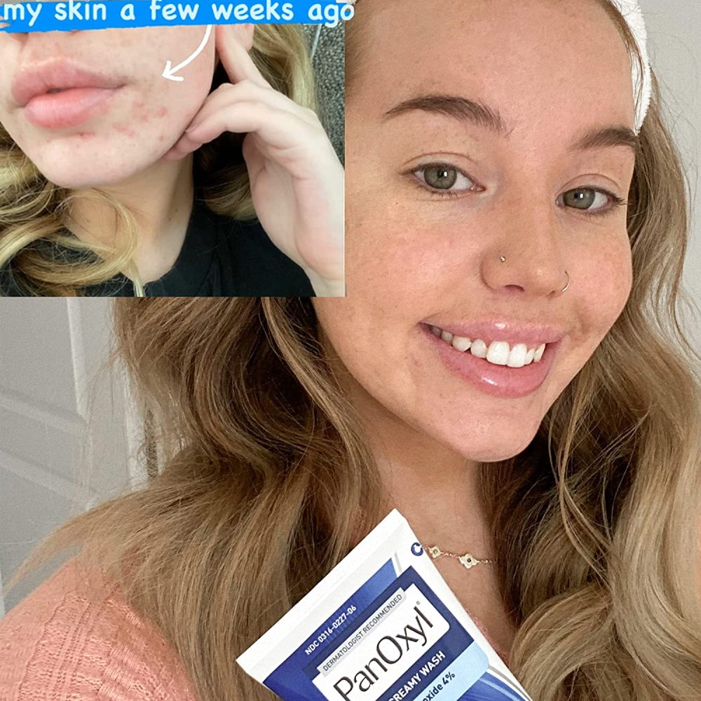 PANOXYL 4% NETTOYANT VISAGE CREMEUX 170 G CONTROLE QUOTIDIEN PANOXYL 4% NETTOYANT VISAGE CREMEUX 170 G CONTROLE QUOTIDIEN
