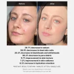 MEDICUBE 1 MIN RED ACNE SUCCINIC ACID PEEL 40 G